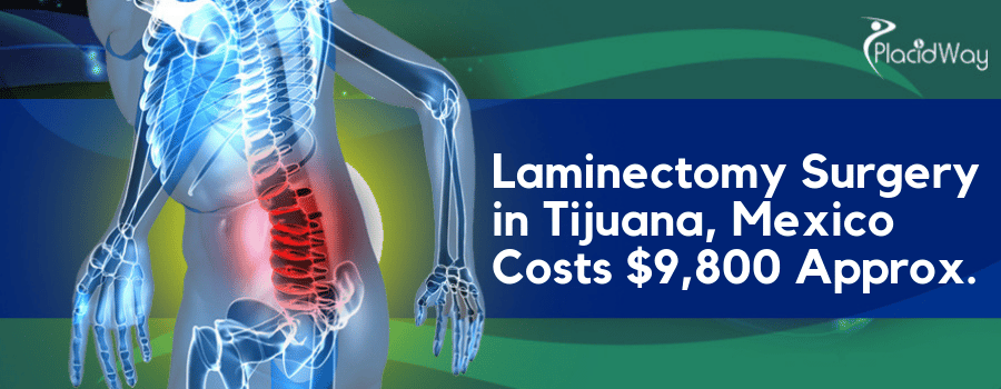 Laminectomy Surgery in Tijuana, Mexico